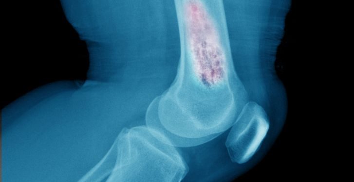 What is a Bone Tumor?