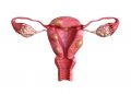 Uterine Cancer