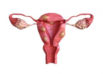 Uterine Cancer