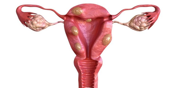 Uterine Cancer