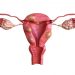 Uterine Cancer