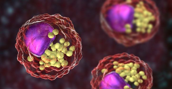 Acute Myeloid Leukemia