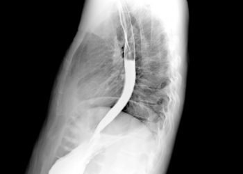 Esophageal Cancer Prognosis