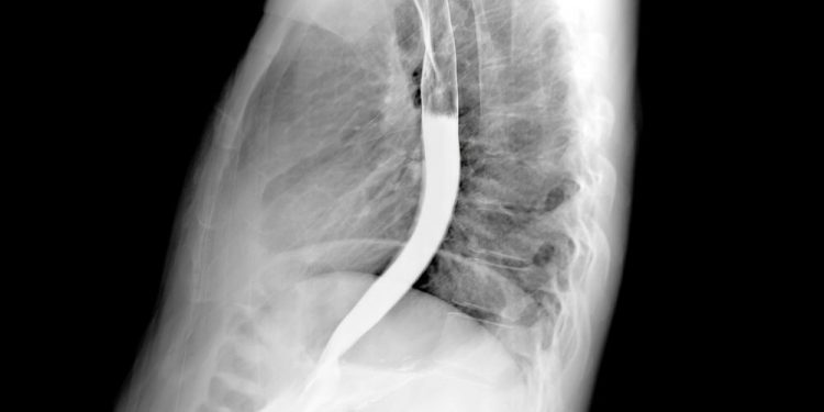 Esophageal Cancer Prognosis