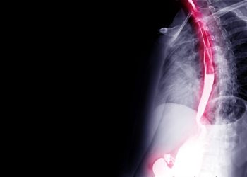 Esophageal Cancer Symptoms