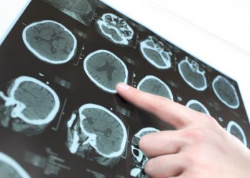 What Are the Causes of Aphasia?