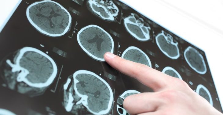 What Are the Causes of Aphasia?