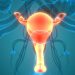 What is a Uterine Cyst?