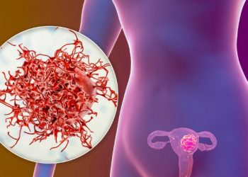 Uterine Polyps Symptoms