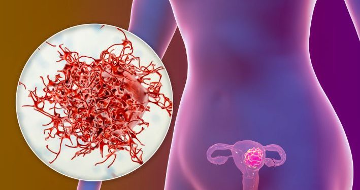 Uterine Polyps Symptoms