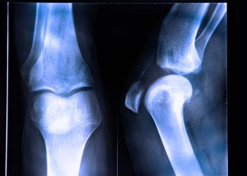 Bone Cancer Treatment