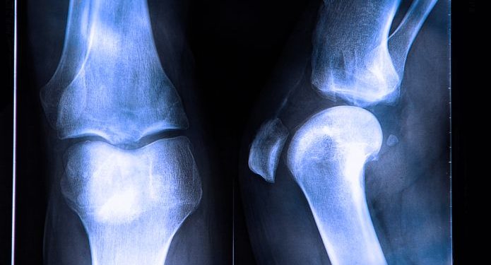 Bone Cancer Treatment