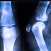 Bone Cancer Treatment