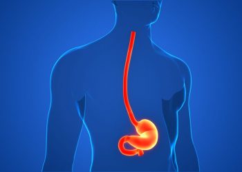 What is an Esophageal Web?