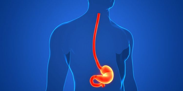 What is an Esophageal Web?