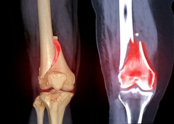 Hip Pain at Night – Is It Cancer?