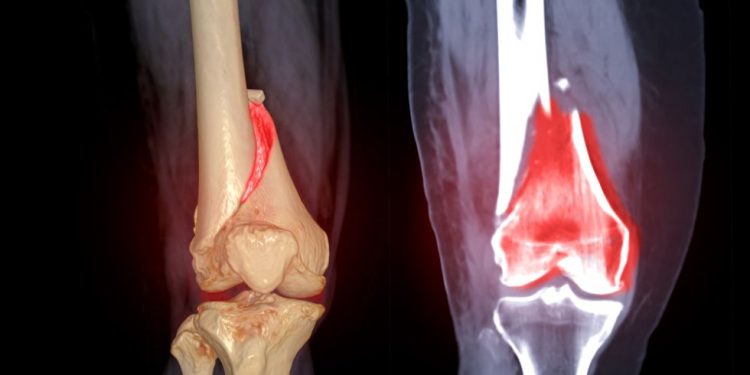 Hip Pain at Night – Is It Cancer?