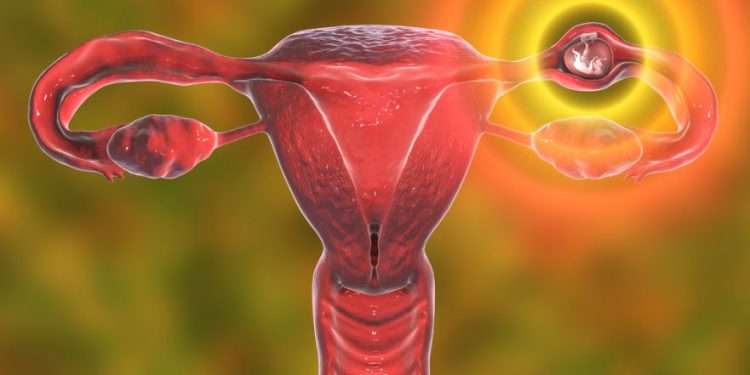 Endometrial Polyps