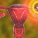 Endometrial Polyps