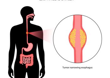 Oesophageal Cancer