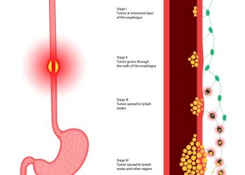 PDQ Cancer Information Summary For Esophageal Squamous Cell Carcinoma