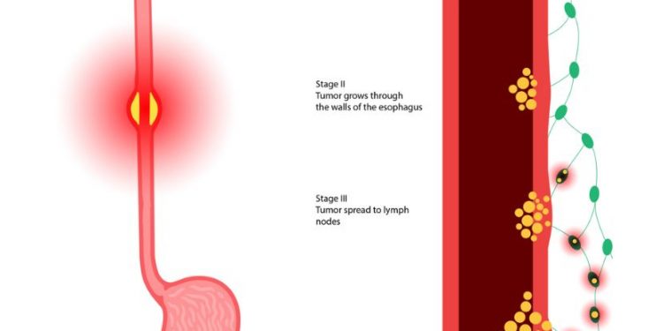 PDQ Cancer Information Summary For Esophageal Squamous Cell Carcinoma