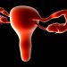 Endometrial Hyperplasia Treatment