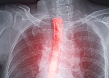 Esophageal Causes of Chest Pain