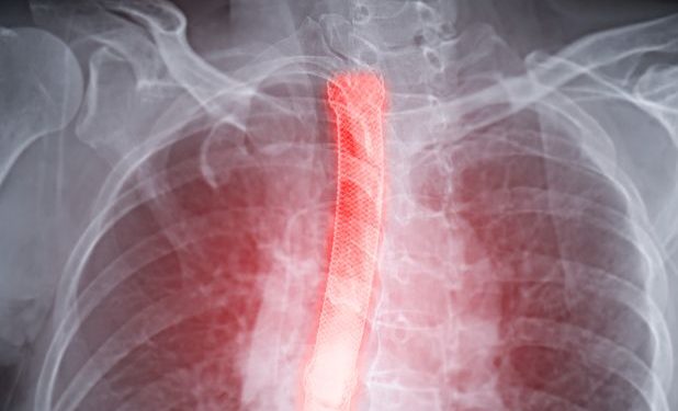 Esophageal Causes of Chest Pain