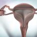 Uterine Cancer Stages