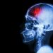 Mini Stroke Symptoms