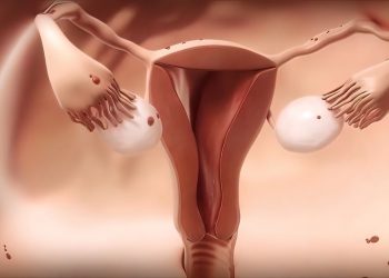 Endometrial Adenocarcinoma