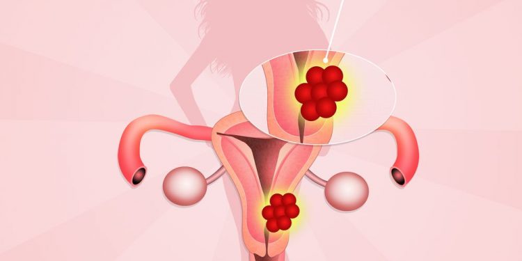 Thick Uterine Lining