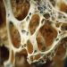 Osteogenic Sarcoma in Children
