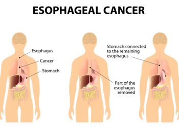 Esophageal Adenocarcinoma Cancer Treatment