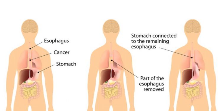 Esophageal Adenocarcinoma Cancer Treatment
