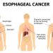 Esophageal Adenocarcinoma Cancer Treatment
