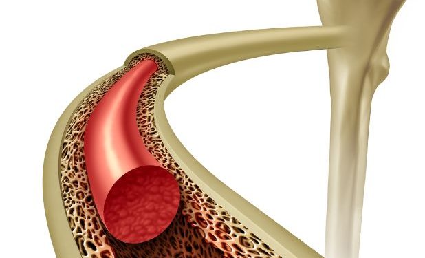 Bone Marrow Transplant For Leukemia