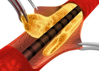Bone Marrow Pain Symptoms of Blood Cancers