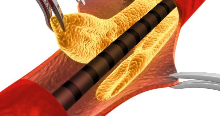 Bone Marrow Pain Symptoms of Blood Cancers