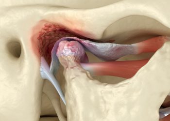 Non Cancerous Bone Marrow Disorders