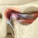 Non Cancerous Bone Marrow Disorders