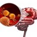 Glioblastoma Cancer