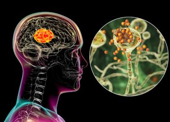 Glioblastoma Stage 4 Treatment