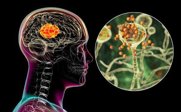 Glioblastoma Stage 4 Treatment