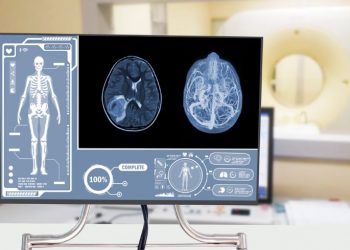 What is a Glioma Brain Tumor?