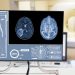 What is a Glioma Brain Tumor?