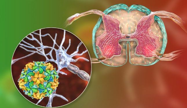 Glioblastoma Multiforme