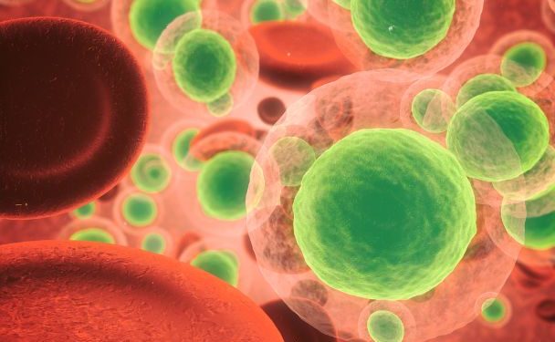 Lepidic Adenocarcinoma