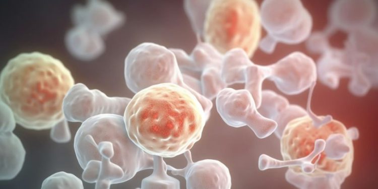 What Is a Weakly Differentiated Adenocarcinoma?